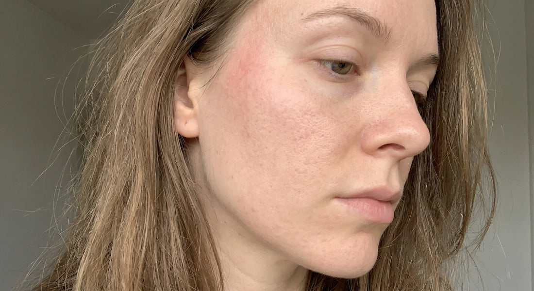 Skin Barrier Repair: What's Actually Broken, and How It Heals