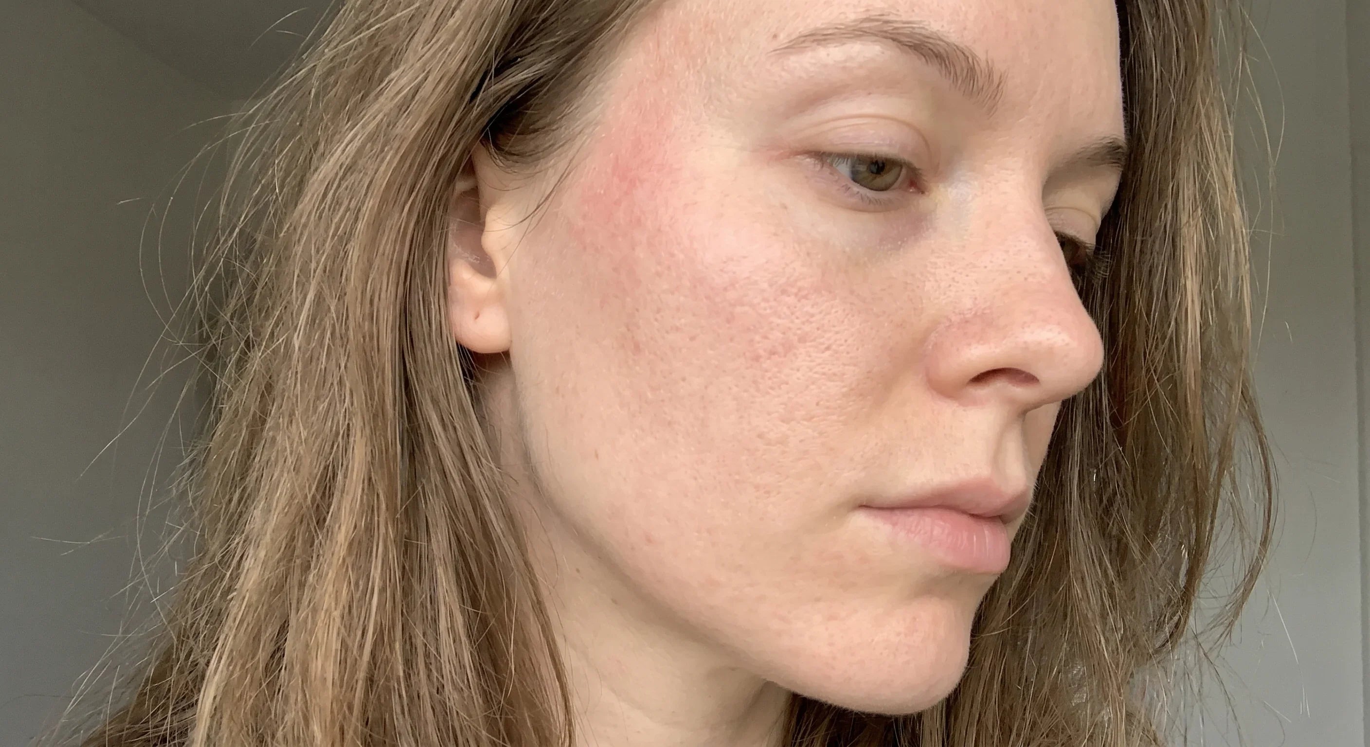 Skin Barrier Repair: What's Actually Broken, and How It Heals